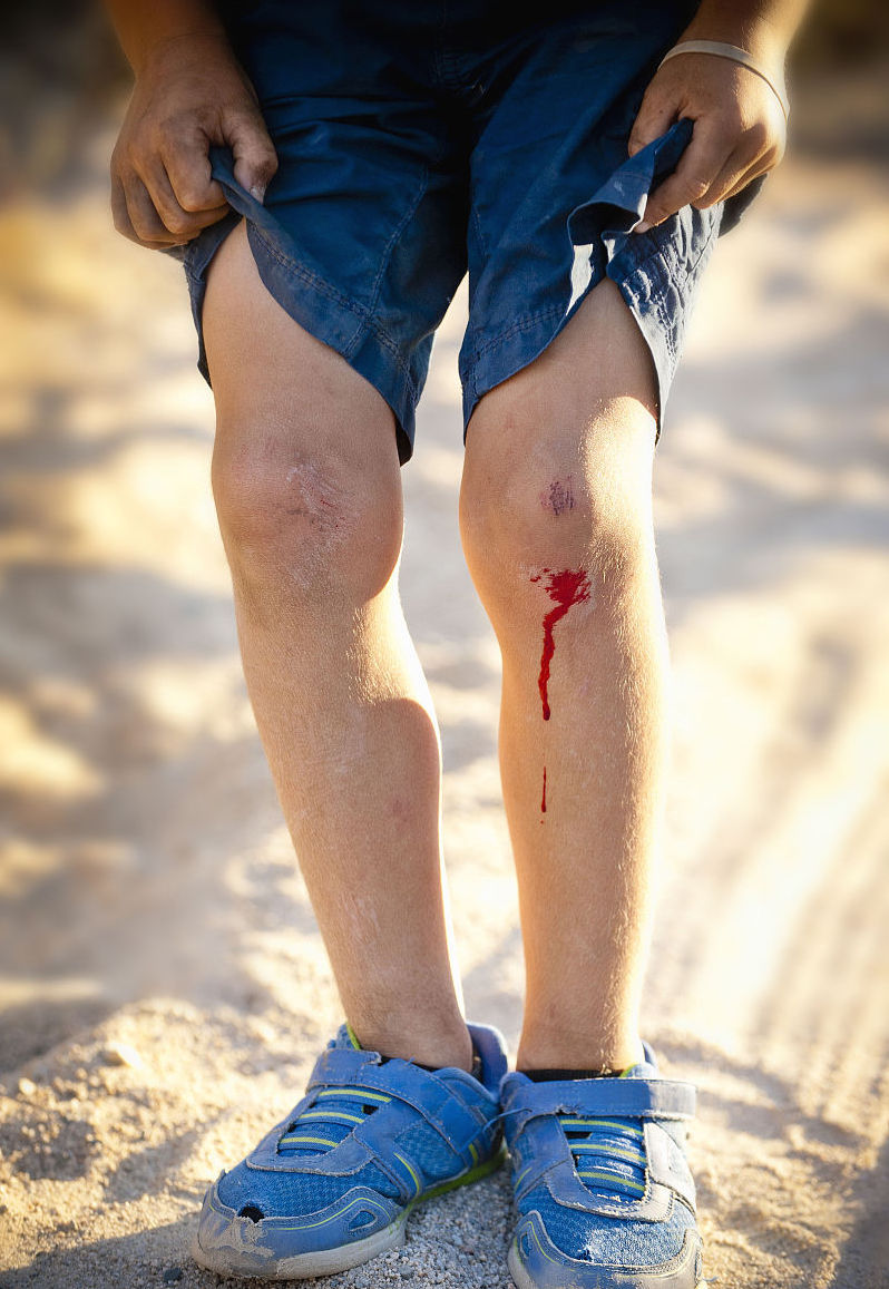 跑步摔倒膝盖破皮第二天流液体,跑步摔跤脸部擦伤肿了