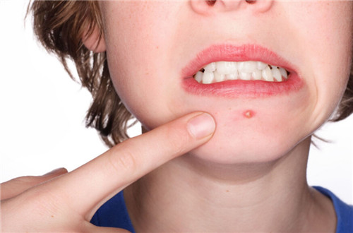 挤完痘痘可以抹精华吗,挤完痘痘可以抹其他皮肤吗