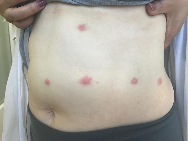 什么蚊虫咬了红疙瘩很痒三天不消,被蚊虫咬了鼓个大包怎么办