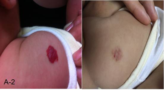 婴幼儿脸上有胎记怎么办,治疗婴幼儿红胎记哪里好