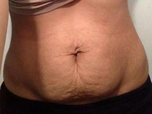 生娃后十天后肚子依然很大怎么办,生完孩子肚子一直下不去怎么办