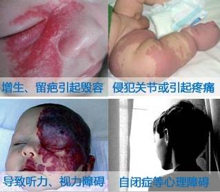 婴幼儿脸上有胎记怎么办,治疗婴幼儿红胎记哪里好