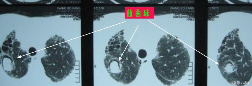 有一种真菌，专门在肺部原有疾病产生的空洞里长小球，消不掉，咳不出，有时候会引起致命大出血