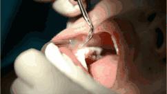 在牙科会感染艾滋病毒吗,在牙科弄牙齿会不会传染艾滋病