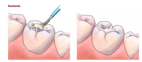 宝宝护牙的四大攻略,牙医爸爸给孩子修牙