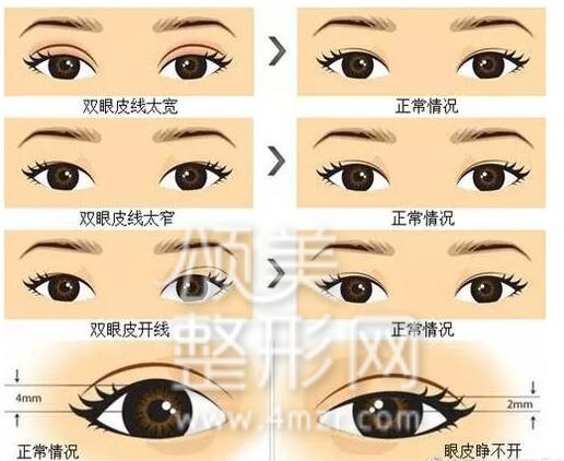 整形医院把双眼皮做失败了怎么办,埋线双眼皮失败后最佳修复时间