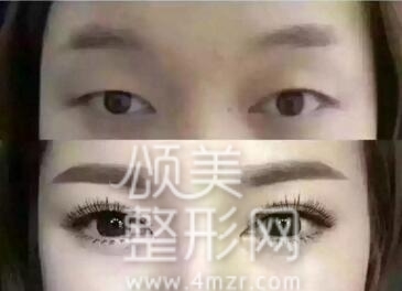 整形医院把双眼皮做失败了怎么办,埋线双眼皮失败后最佳修复时间