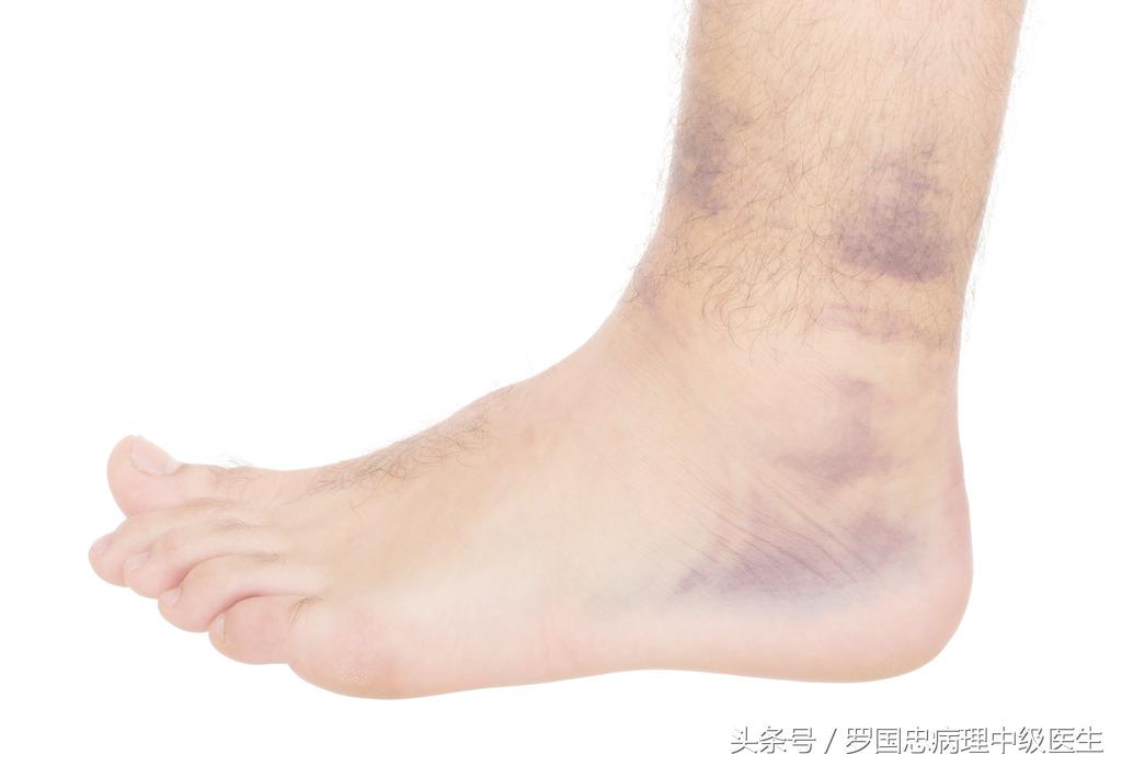 舒筋活络膏骨折可以用嘛,舒筋活络膏骨折