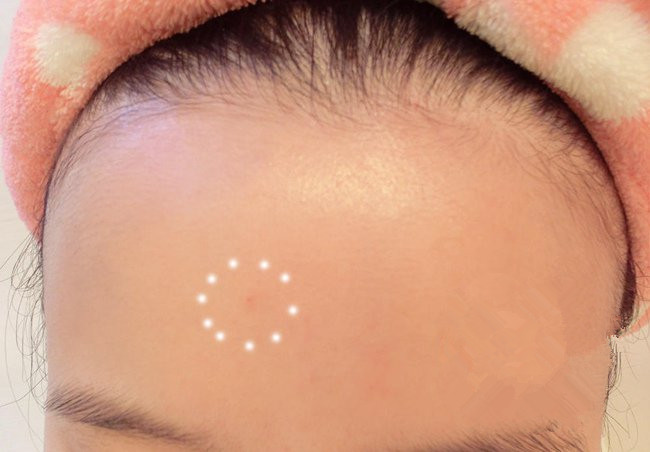 怎么祛额头痘痘简单方法,如何消除额头痘痘的小妙招