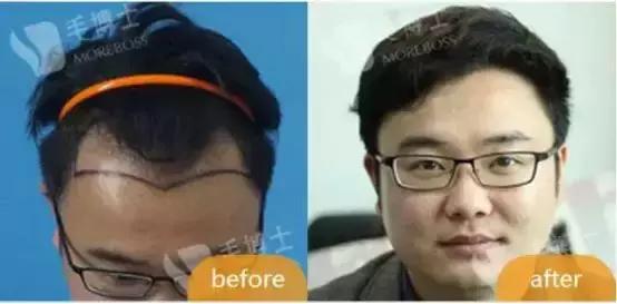 遗传性脱发有什么治疗方法,遗传性脱发用米诺地尔有效吗