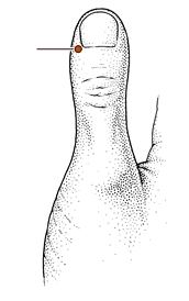 心烦失眠针灸,心烦针灸哪个穴位