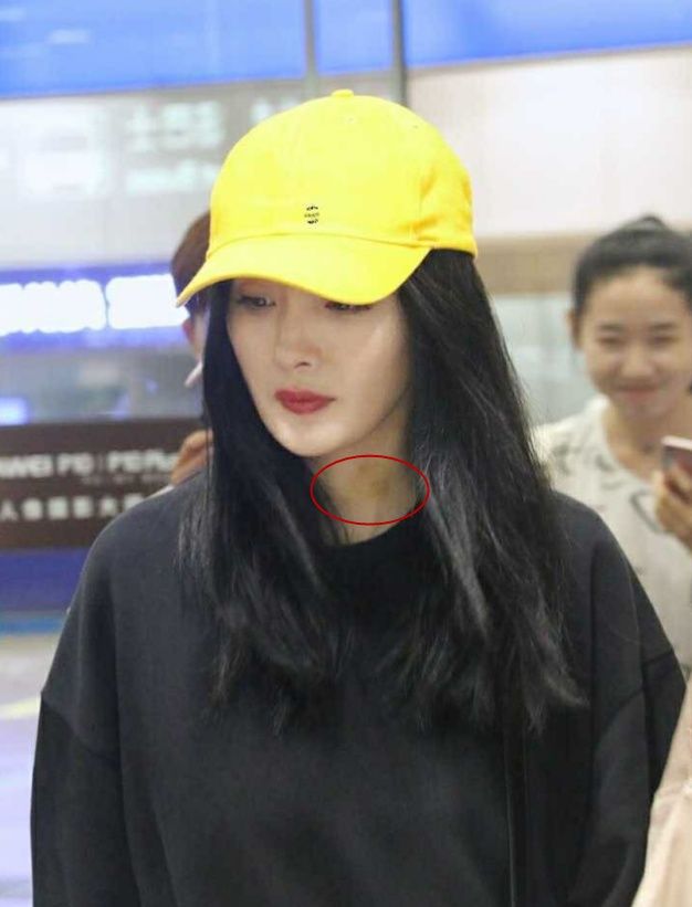 杨幂感冒发烧,杨幂针灸放血治疗