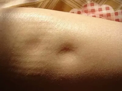 脚肿是快要临产的表现吗,分娩后腿肿怎么回事