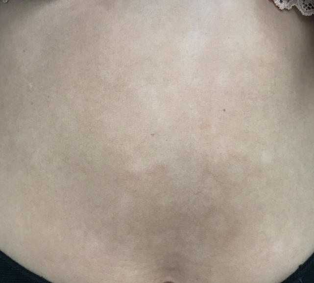 女生肚子上出现斑点,肚子上有一块白白的汗斑怎么治