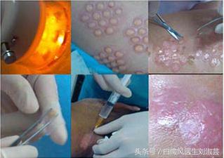 祛白癜风,彻底治疗白癜风的特效药