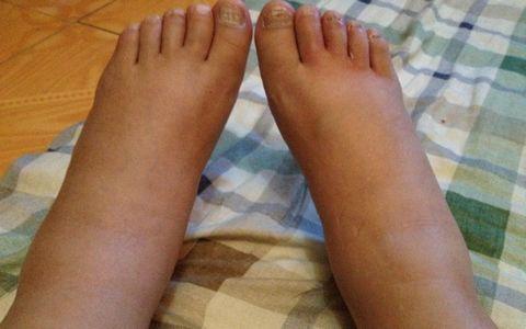 下巴长痘是清热解毒还是祛湿,下巴发黑长痘是不是体内有毒素