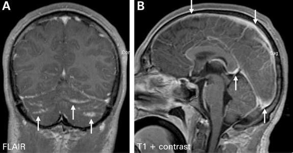 新型隐球菌脑膜炎好转症状,新型隐球菌脑膜炎症状儿童