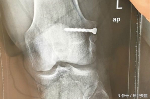 心酸：17岁镶钢钉延续足球梦，13年后取出再圆梦，曾在球场跪地告慰亡父