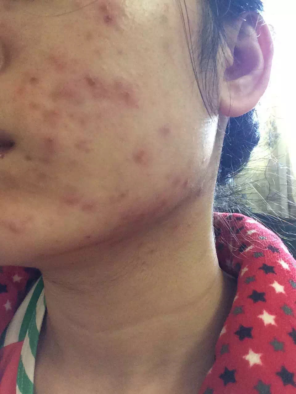 慎入！春季多发激素脸！你还要不要脸？