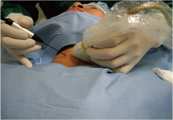 甲状腺微创介入治疗技术成熟吗,超声介入治疗桥本氏甲状腺炎