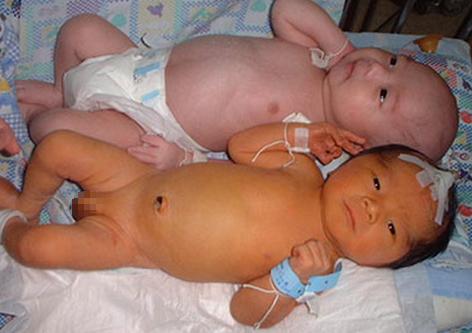 宝宝黄疸高怎么可以让黄疸退下来,黄疸有什么危险