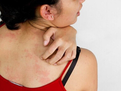 牛皮癣怎么治才能彻底根除牛皮癣,牛皮癣怎么办才能彻底治好