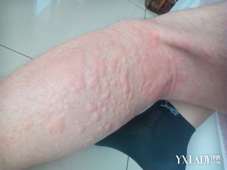 身上起红疙瘩像过敏是怎么回事,身上起疙瘩过敏了怎么办
