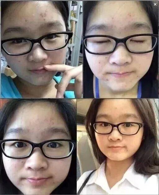 痘痘清洁护肤步骤,痘痘肌肤的最佳修复方法