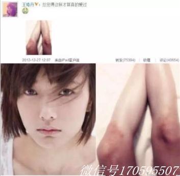 祛疤妙招—日本处方祛疤膏