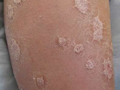 牛皮癣怎么治才能彻底根除牛皮癣,牛皮癣怎么办才能彻底治好