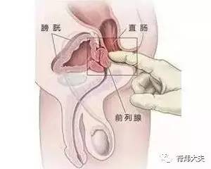 得了直肠前突多吃青菜能预防吗,得了直肠前突怎么治疗