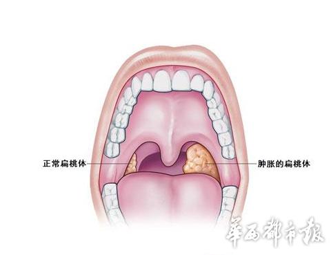 扁桃体反复发炎是免疫力下降吗,扁桃体反复发炎可能是大病警报