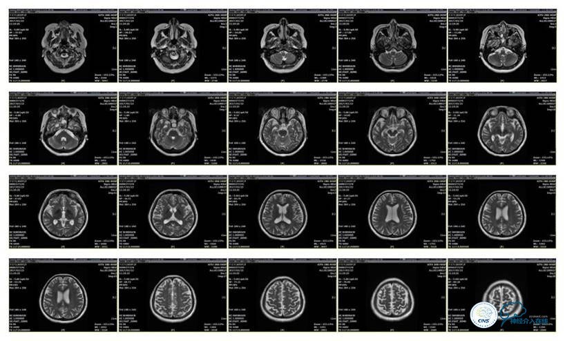 静脉窦狭窄支架植入术,静脉窦狭窄做支架多少钱