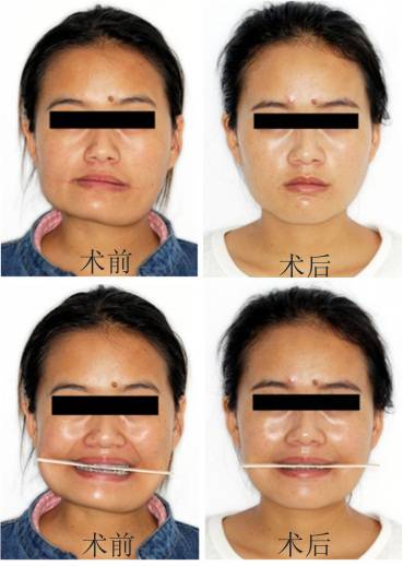 龅牙地包天怎么弄,龅牙怎么解决最好