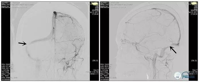 静脉窦狭窄支架植入术,静脉窦狭窄做支架多少钱