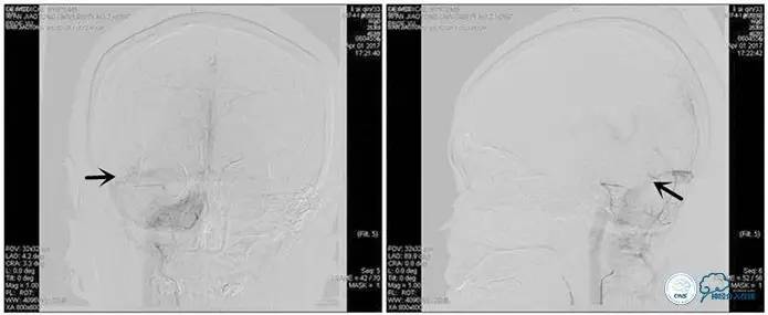静脉窦狭窄支架植入术,静脉窦狭窄做支架多少钱