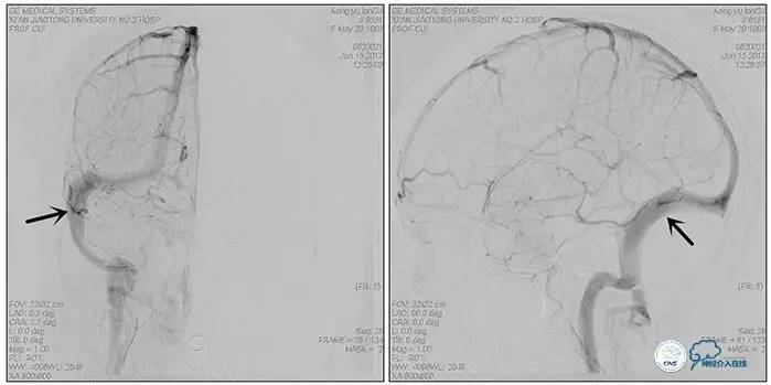 静脉窦狭窄支架植入术,静脉窦狭窄做支架多少钱