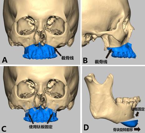 龅牙地包天怎么弄,龅牙怎么解决最好
