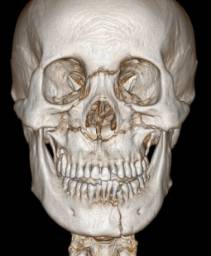 龅牙地包天怎么弄,龅牙怎么解决最好