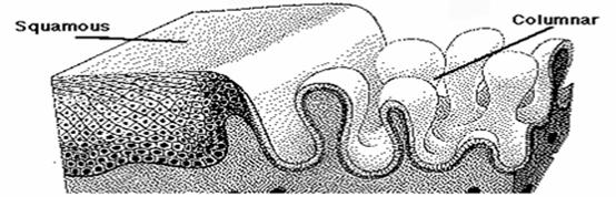 宫颈糜烂会诱发什么疾病,宫颈糜烂现在还是病么