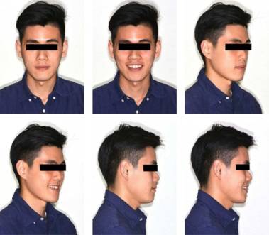 龅牙地包天怎么弄,龅牙怎么解决最好