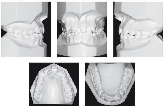 龅牙地包天怎么弄,龅牙怎么解决最好