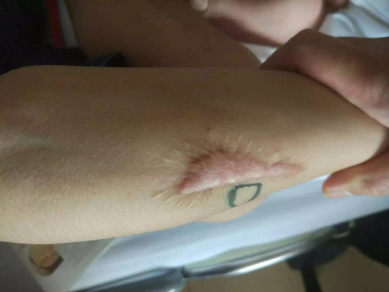 30年的手术疤痕,28年的手术疤痕