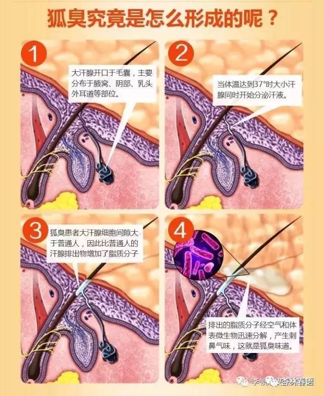 长沙黄金微针去狐臭的价格,黄金微针祛狐臭能维持多久
