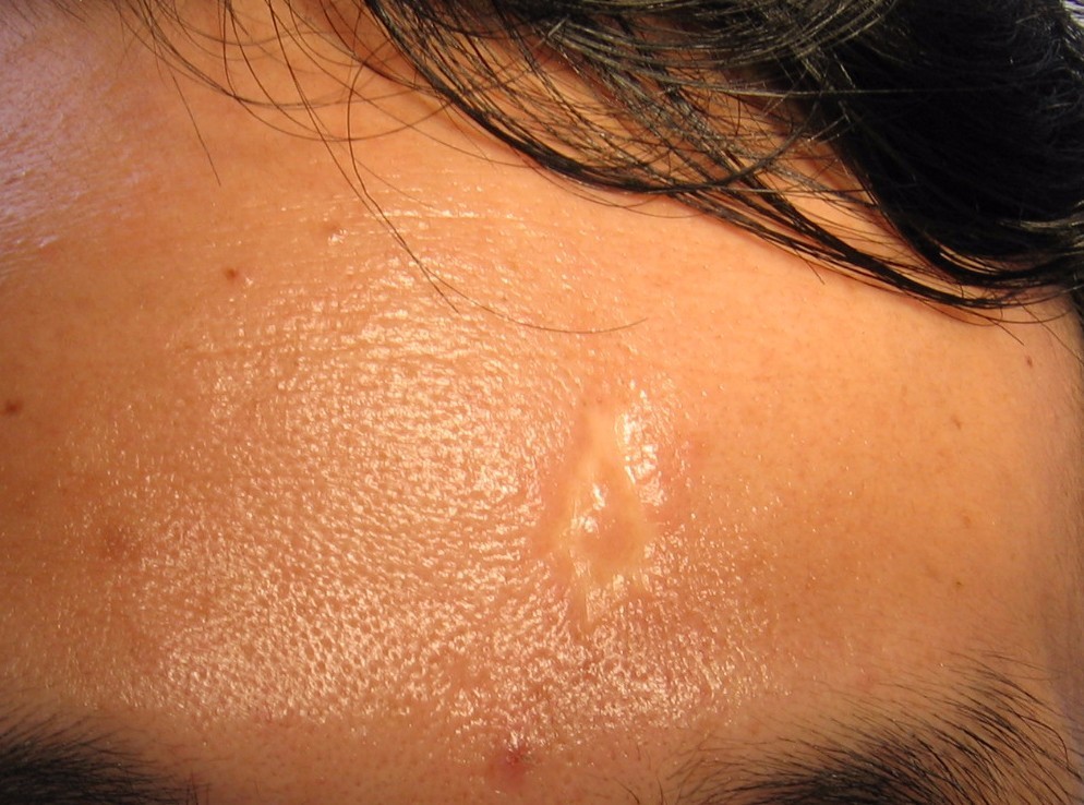 30年的手术疤痕,28年的手术疤痕