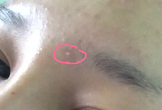 最全战痘攻略,战痘100种祛痘方法