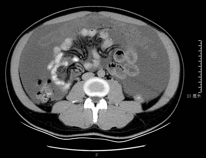 腹胀是怎么回事谨慎是这里生病了,腹胀是什么原因引起的胃不舒服