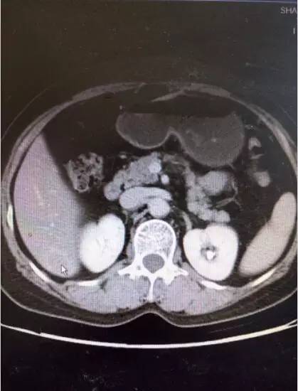 直肠神经内分泌肿瘤良性转移快吗,直肠神经内分泌瘤肝转移的后果