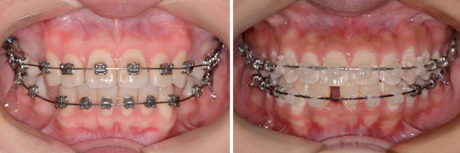 龅牙地包天怎么弄,龅牙怎么解决最好