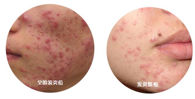 最全战痘攻略,战痘100种祛痘方法
